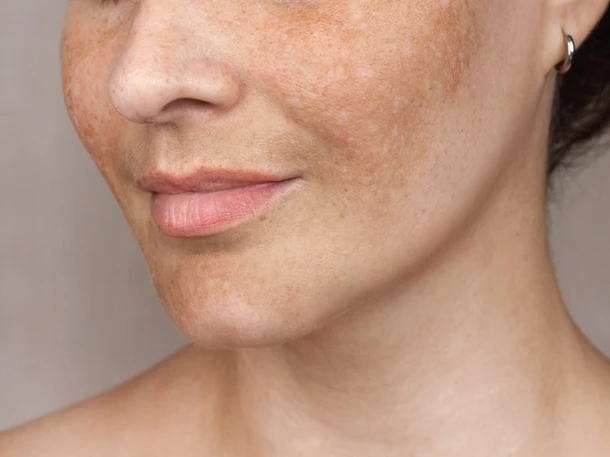 Pigmentflekker behandling Fornebuklinikken