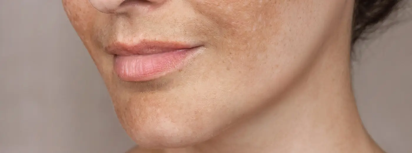 Pigmentflekker behandling Fornebuklinikken