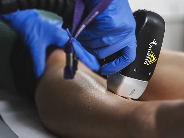 Permanent hårfjerning med laser