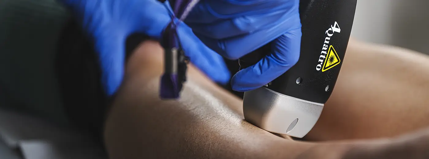 Permanent hårfjerning med laser