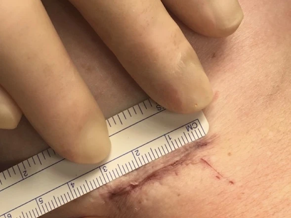 Mini-invasiv brystforstørrelse