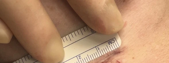 Mini-invasiv brystforstørrelse