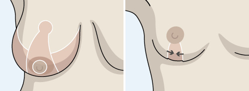 brystreduksjon-prosess